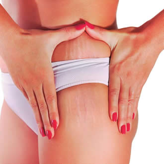 Leia mais sobre o artigo Dicas da Pelle: Estrias