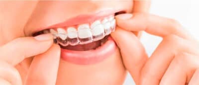 Mude o seu sorriso com a ortodontia digital