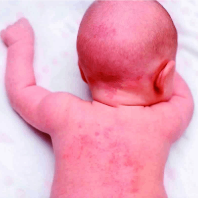 Saiba como lidar com as brotoejas!