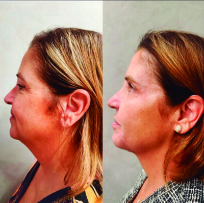 Rejuvenescimento facial