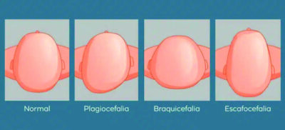 Assimetria craniana nos bebês